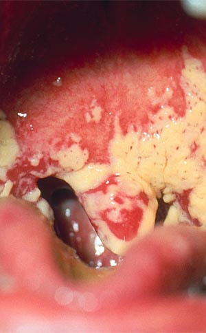 Mouth Thrush Yeast Infection Picture