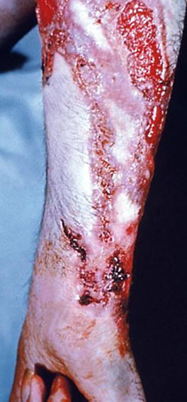 Sporotrichosis (Rose Gardener's Disease) Picture