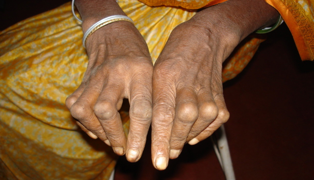 Arthritis in Hands Picture
