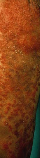 Cutaneous Candidiasis Yeast Infection Picture