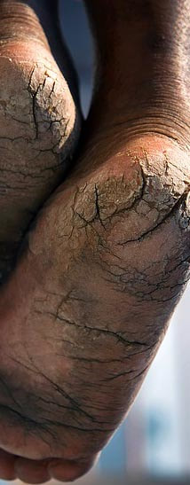 Dry Cracked Skin Picture