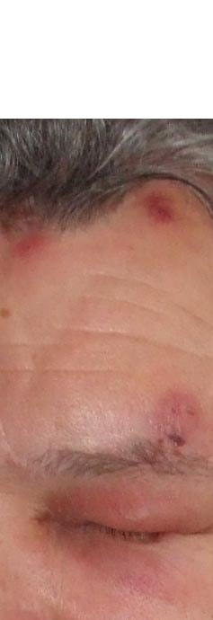 Herpes Zoster Skin Infection Picture