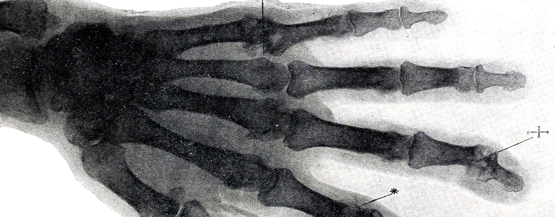 Tophi X-ray Banner Picture